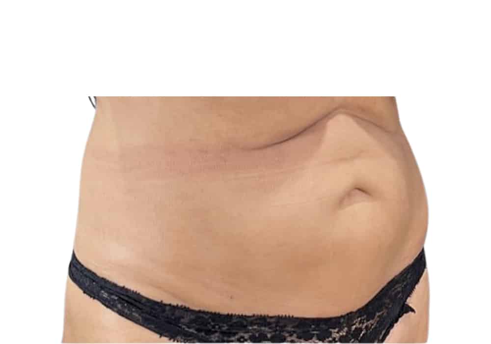 abdominale-before-2