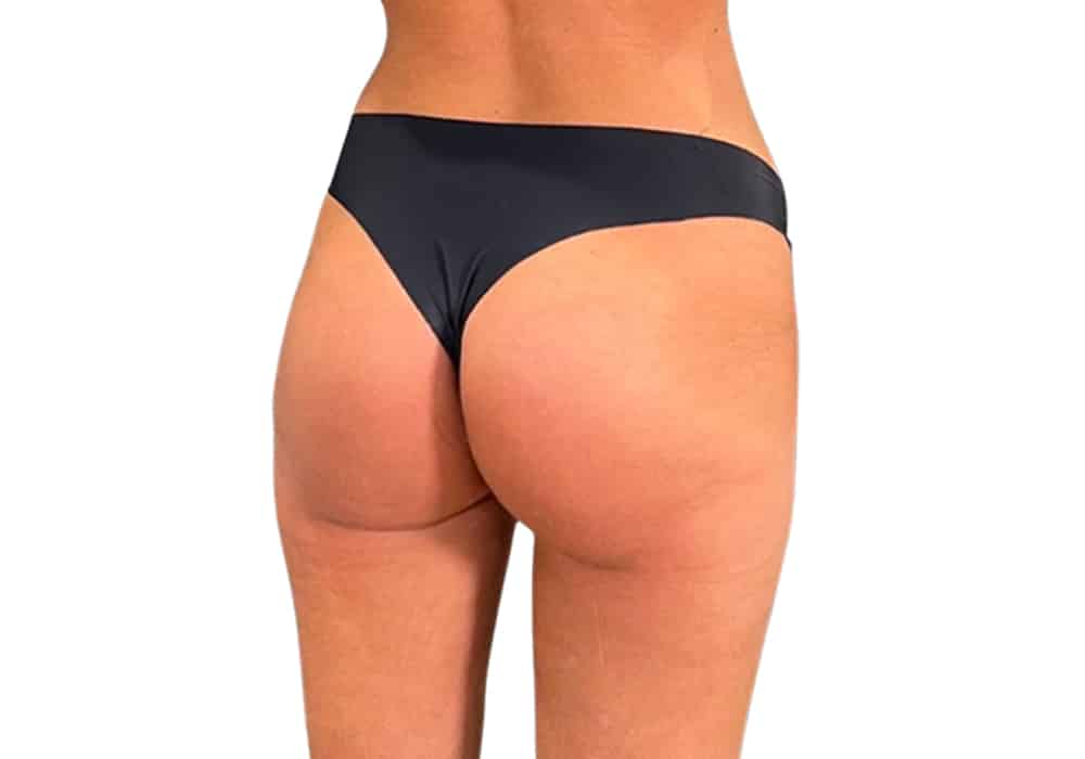 chirurgie-fesse-after-1