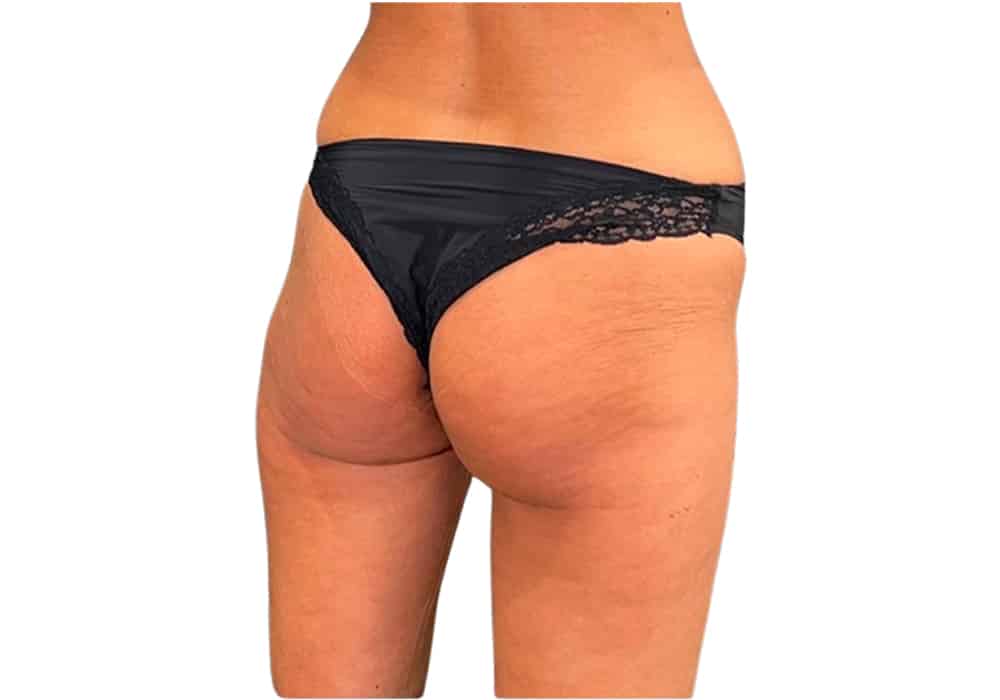 chirurgie-fesse-before-1