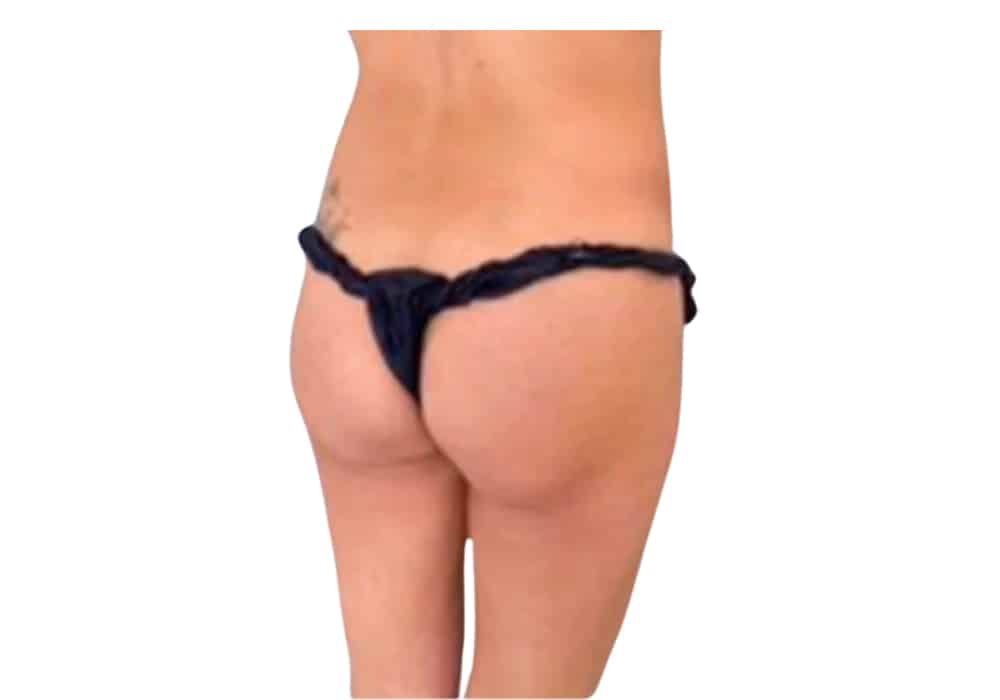 chirurgie-fesse-before-2