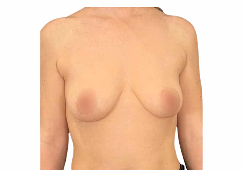 chirurgie-seins-before-1