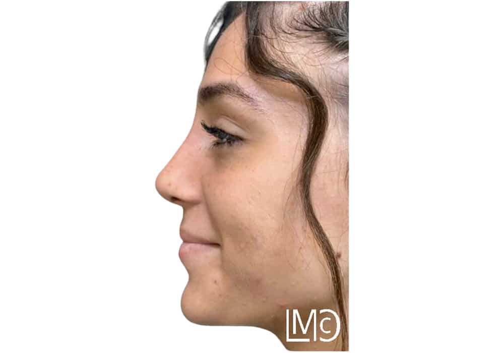 rhinoplastie-after-2