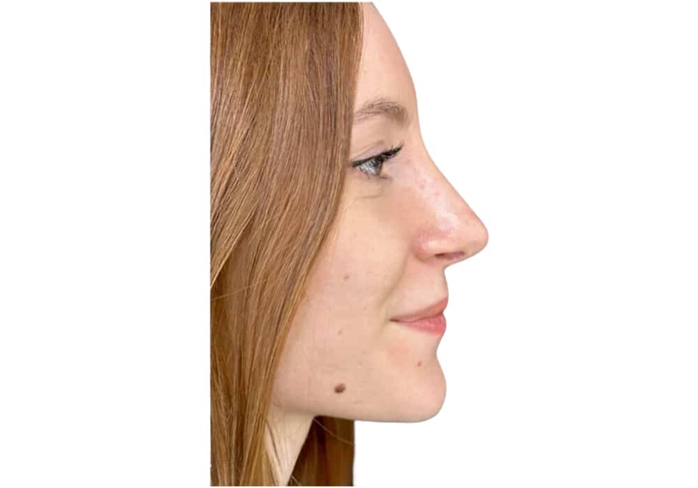 rhinoplastie-after-3