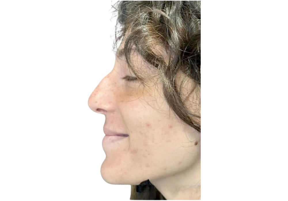 rhinoplastie-before-2