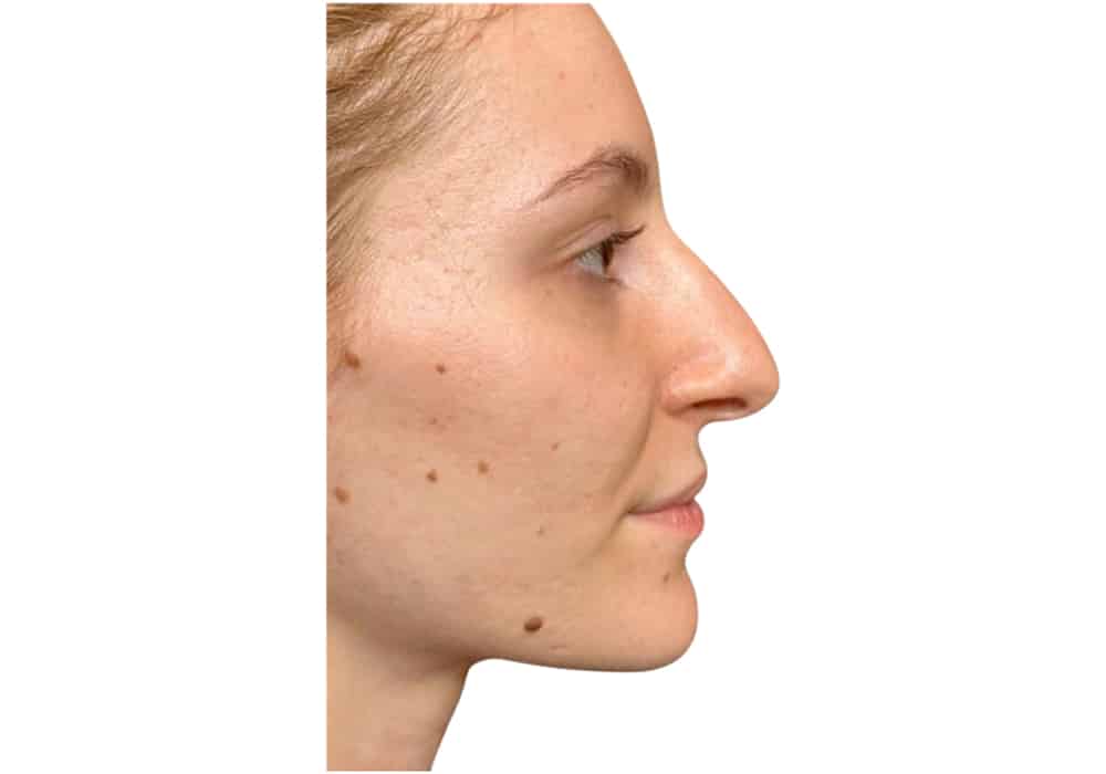 rhinoplastie-before-3