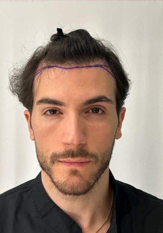 AVANT APRES CHEVEUX(1)